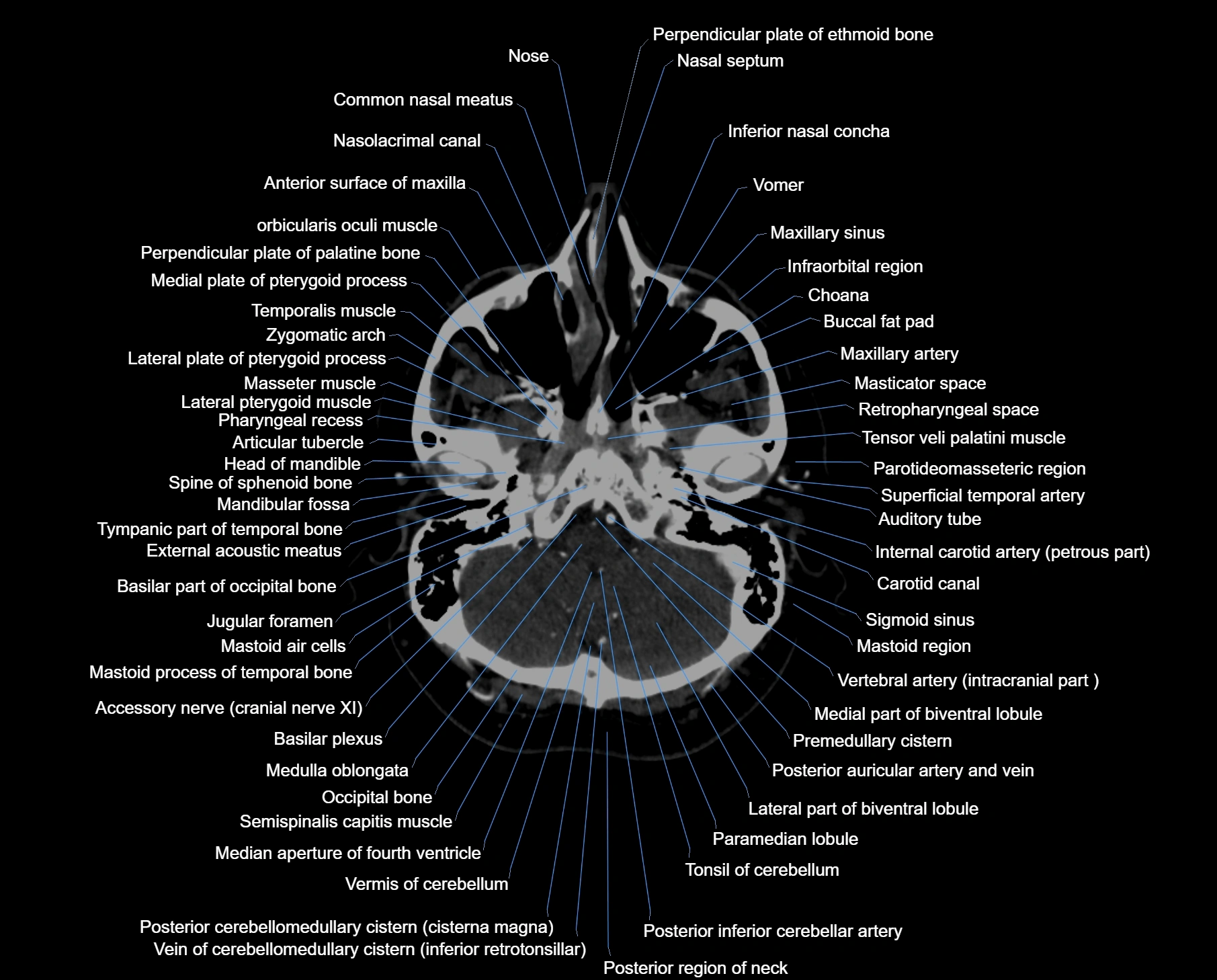 CT scan brain axial labelled cross sectional anatomy image-img-000010.webp